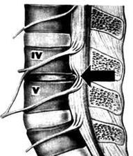 X -Ray Slika ledvenega oddelka za osteohondrozo