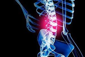 osteohondroza ledvene hrbtenice
