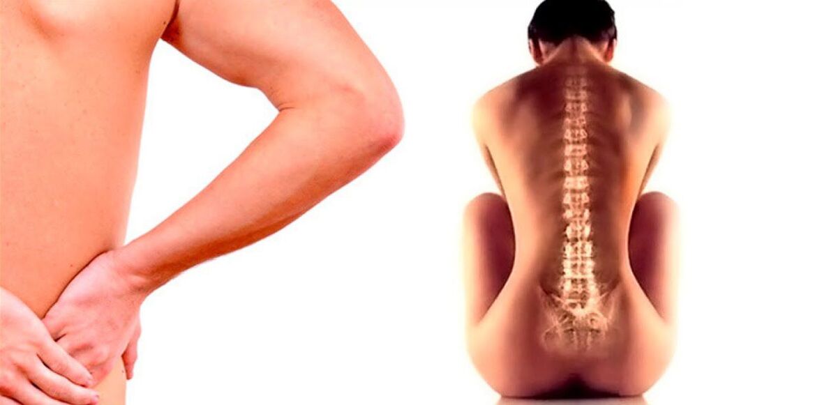 bolečine v spodnjem delu hrbta zaradi osteohondroze