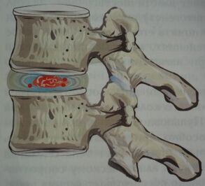 Prva stopnja osteohondroze