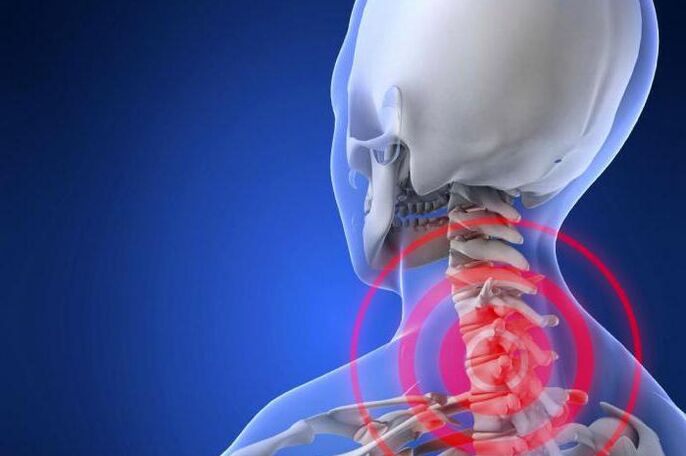Streljajoča bolečina v vratu je zgodnji simptom cervikalne osteohondroze