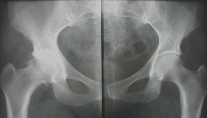 rentgensko slikanje prizadetega kolčnega sklepa z artrozo